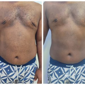 Cópia de CRIOLIPOLISE 1 SESSÃO ANTES E DEPOIS