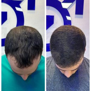 Cópia de TRASPLANTE APOS 6 MESES EM EVOLUÇÃO